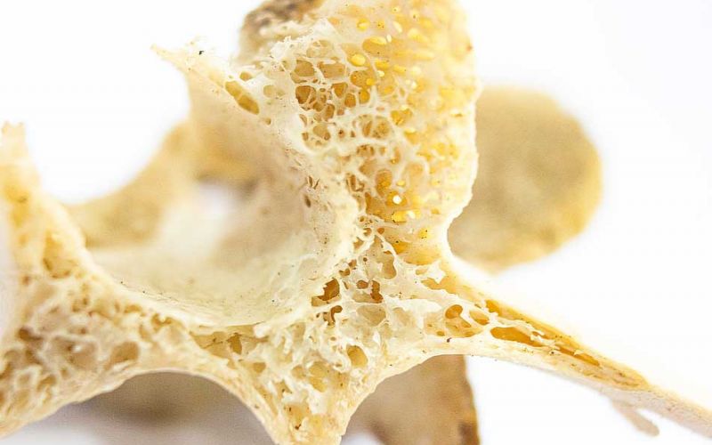 Osteoporose und der Stellenwert von Übungstherapie zur Verbesserung der Knochendichte