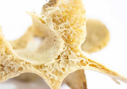 Osteoporose und der Stellenwert von Übungstherapie zur Verbesserung der Knochendichte